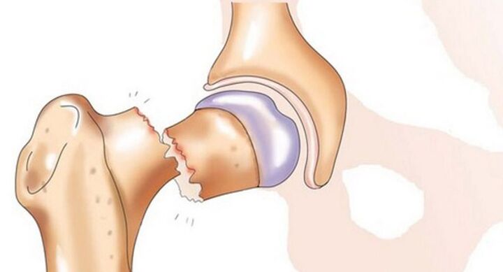 شکستگی گردن فمور با درد شدید در مفصل ران همراه است