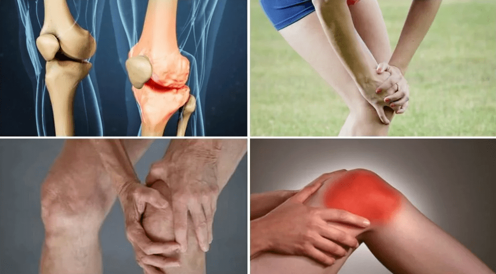 علائم آرتروز